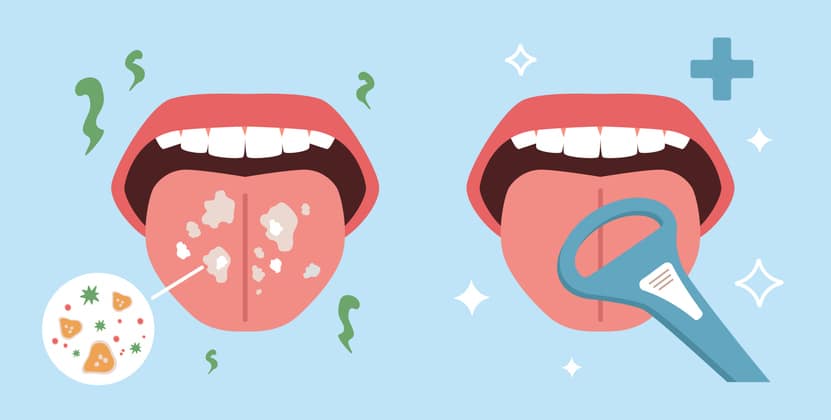 Photos de deux langues une chargée de bactéries l'autre propre et saine grâce au gratte langue